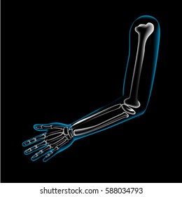 Arm bone and finger bone,pain,x ray