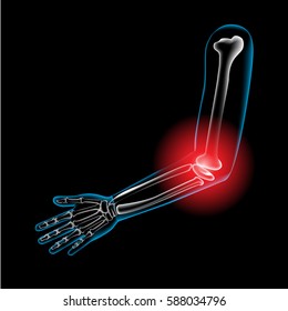 Arm bone and finger bone,pain,x ray