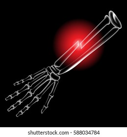 Arm bone and finger bone, pain, x ray, broken arm