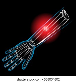 Arm bone and finger bone, pain, x ray, broken arm