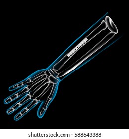 Arm bone and finger bone, pain, x ray, broken arm, Pins and screws to hold the bones