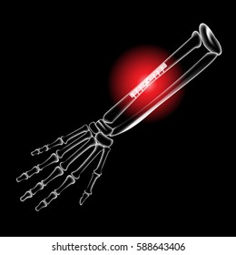 Arm bone and finger bone, pain, x ray, broken arm, Pins and screws to hold the bones