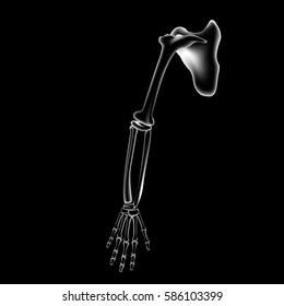 Arm and finger bone, bone pain, x ray