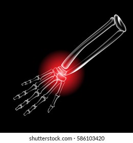 Arm and finger bone, bone pain, x ray