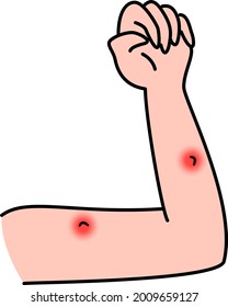 Mordida de insectos en el brazo, picor, material de ilustración inflamado