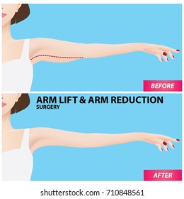 Arm Lift And Reduction Surgery Vector Illustration