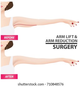 Arm lift and reduction surgery vector illustration