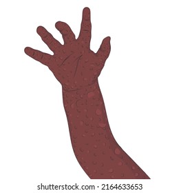 Arm with monkey pox, example of contagion.	