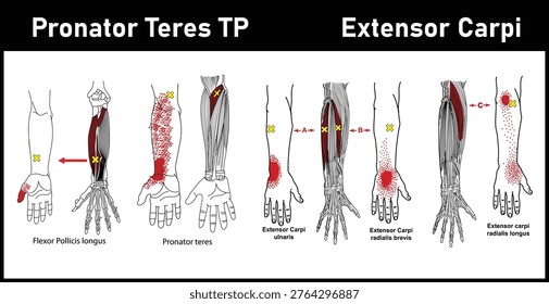 Arm pain trigger points, Myofascial Trigger Point, Pronator Teres TP, Extensor carpi