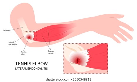 Arm tendon and muscle inflammation pain with anatomy of Lateral epicondylitis or called Golfer’s tennis elbow