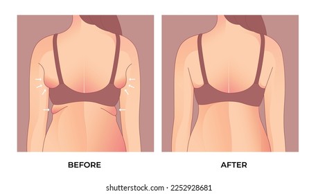 Armpit fat before and after  Brachioplasty, liposuction or plastic surgery, woman body shape transformation, Fat To Fit. 