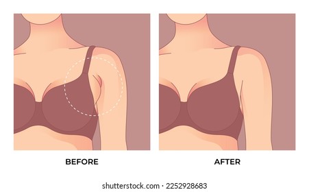 Armpit fat before and after  Brachioplasty, liposuction or plastic surgery, woman body shape transformation, Fat To Fit. 
 svg