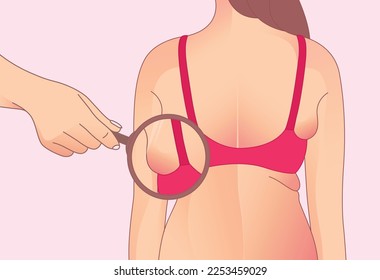 Armpit fat, Brachioplasty, liposuction or plastic surgery, woman body shape transformation, Fat To Fit. 