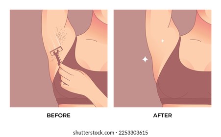 Armpit Hair before and after laser waxing. svg