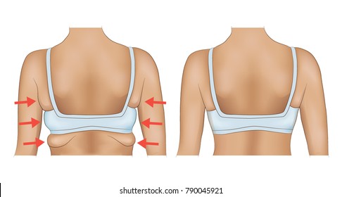 Armpits fat of a woman with arrow designation. Armpits fat before and after diet or surgery