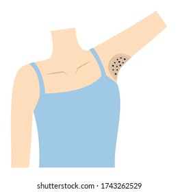 Armpits of women who are dark due to pigmentation and buried hair