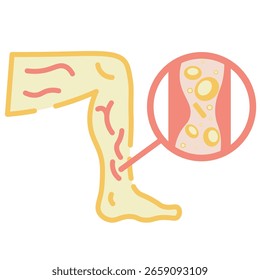 Vector de trombosis arterial que muestra bloqueo de la arteria, dolor torácico, entumecimiento y debilidad. Destaca los riesgos relacionados, como ataque cardíaco y accidente cerebrovascular. Ilustración minimalista de estilo médico. Vector de la pierna