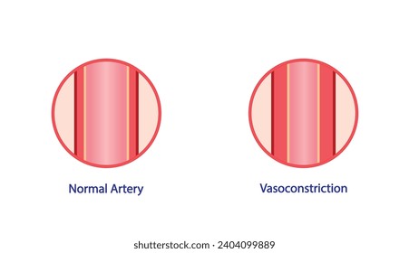 Arterielle Vasokonstriktion. Kreuzung der Arterien. Vergleich normaler und eingeendeter Blutgefäße. Wissenschaftliches Diagramm. Vektorgrafik.