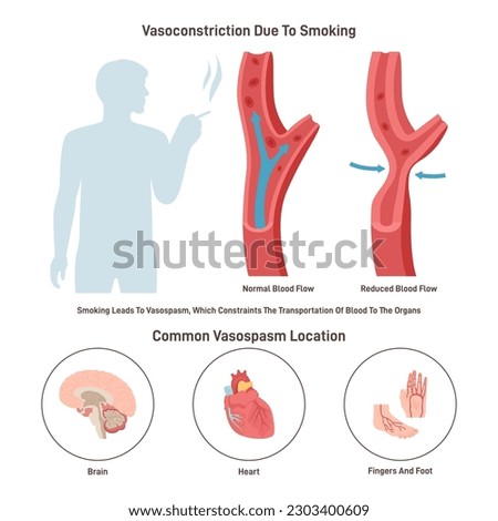 Arterial vasoconstriction. Normal and constricted blood vessels caused by smoking. Nicotine leads to reduced blood flow. Flat vector illustration