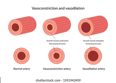 Arterial Vasoconstriction And Vasodilation. Comparison Illustration Of Normal, Constricted, And Dilated Blood Vessels. Diagram With Description Of The Main Parts. Vector Illustration