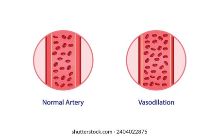 Vasodilatación arterial. Sección transversal de las arterias. Comparación de los vasos sanguíneos normales y dilatados. Diagrama Científico. Ilustración vectorial.