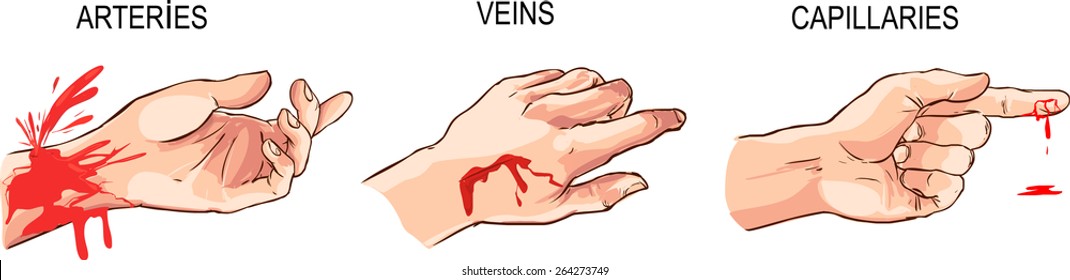 Arterial And Venous Bleeding