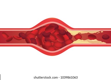 Arteries Swelling Because Blood Clot By Fat Cloged Made Blood Flow Slowly. Illustration About Danger Of Cholesterol.