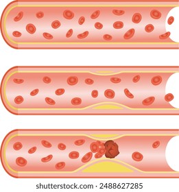 Arteriosclerosis image 2
The progression of arteriosclerosis is depicted in three stages.