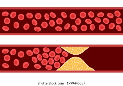 Ischemia の画像 写真素材 ベクター画像 Shutterstock