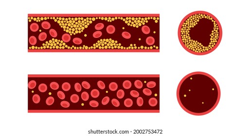 Ischemia の画像 写真素材 ベクター画像 Shutterstock