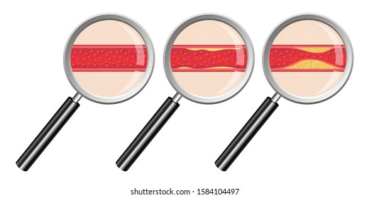 Arteriosclerosis vector design illustration isolated on white background