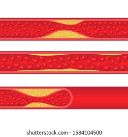 Arteriosclerosis vector design illustration isolated on white background