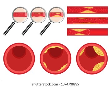 Arteriosclerosis vector design illustration isolated on white background