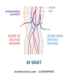 Arteriovenous dialysis shunt graft catheter for hemodialysis sessions. Arm with surgically inserted tube connecting artery to vein under skin. Medical vector illustration.