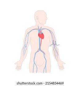 Arteriovenous Dialysis Shunt Graft Catheter For Hemodialysis Sessions. Man With Surgically Inserted Tube Connecting Artery To Vein Under Skin. Medical Vector Illustration.