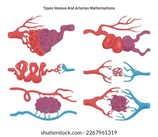 Malformación arteriovenosa o tipos AVM establecidos. Los vasos sanguíneos enmarañados que conectan arterias y venas en el cuerpo humano. Enfermedad de los vasos sanguíneos. Ilustración vectorial plana