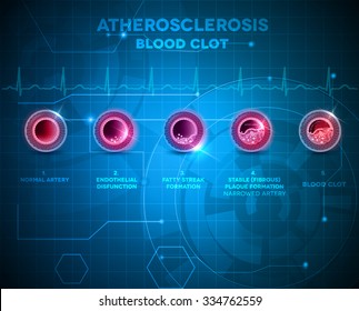 Artery Anatomy And Atherosclerosis Formation, Finally Blood Clot On An Abstract Blue Technology Background.