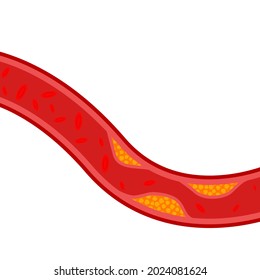 artery blocked with cholesterol. vector illustration. blood pressure design