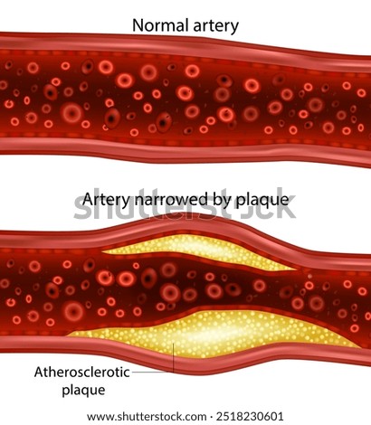 Artery narrowed by plaque and Normal artery. Atherosclerotic plaque. Cholesterol plaque in artery  