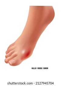 Arthritic Hallux Rigidus Bunion Rheumatoid Sore Joints, Top View.