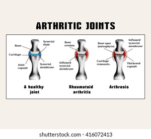 Arthritic joins (rheumatoid arthritis, arthrosis (osteoarthritis)).
The disease of the joints.