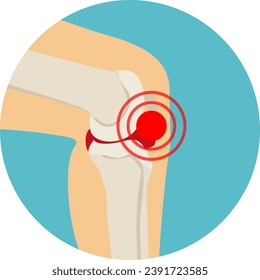 Arthritis or arthrosis of the knee-joint. Аnatomy of the knee joint. Vector illustration in flat style.