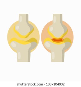 Arthritis. Disease of joints. Red sore spot. Cartoon illustration.