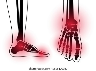 Arthritis foot joint in front and side view. Rheumatoid arthritis. Pain in leg. Human bone anatomy flat vector illustration. Skeleton x ray scan concept. Painful injury and erosion on a medical poster