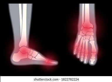 Arthritis foot joint in front and side view. Rheumatoid arthritis. Pain in leg. Human bone anatomy flat vector illustration. Skeleton x ray scan concept. Painful injury and erosion on a medical poster