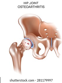 Arthritis of the hip joint, damaged joint cartilage and osteophytes.