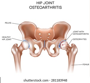 Arthritis Of The Hip Joint, Healthy Joint And Unhealthy Joint With Damaged Cartilage And Osteophytes.