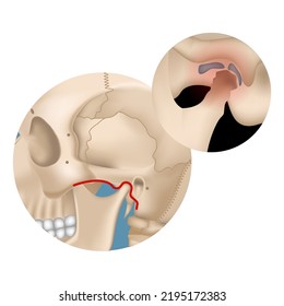 Arthritis of the jaw joint. Head bones inflammation infographic with designation. Medical poster. Vector illustration