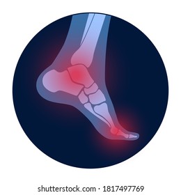 Arthritis joint in the ankle. Osteoarthritis logo for clinic. Leg pain icon. Human foot bone anatomy flat vector illustration. Skeleton x ray scan concept. Painful injury and erosion. Medical poster.