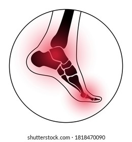 Arthritis joint in the ankle. Osteoarthritis logo for clinic. Leg pain icon. Human foot bone anatomy flat vector illustration. Skeleton x ray scan concept. Painful injury and erosion. Medical poster.